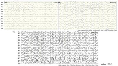 Case Report: Novel SLC9A6 Splicing Variant in a Chinese Boy With Christianson Syndrome With Electrical Status Epilepticus During Sleep